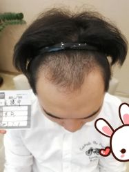 -大麦微针植发丨全国连锁