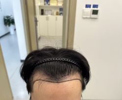 -大麦微针植发全国连锁