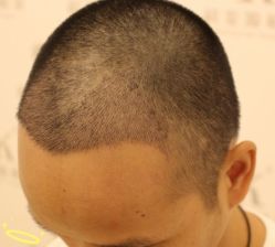 -大麦微针植发丨全国连锁