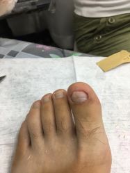 点击看大图 -德哥灰指甲脚气甲沟炎跖疣护理
