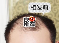 -大麦微针植发全国连锁