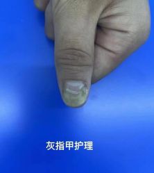 -德哥灰指甲脚气甲沟炎跖疣护理