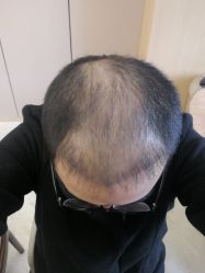 点击看大图 -大麦微针植发丨全国连锁