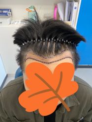 -大麦微针植发全国连锁