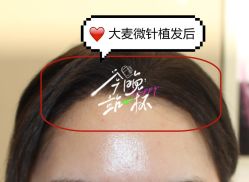 -大麦微针植发全国连锁
