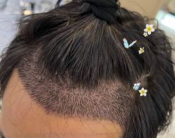 -大麦微针植发全国连锁