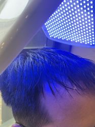 -碧莲盛·不剃发植发