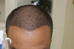 -大麦微针植发丨全国连锁