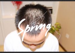 点击看大图 体验后-大麦微针植发全国连锁