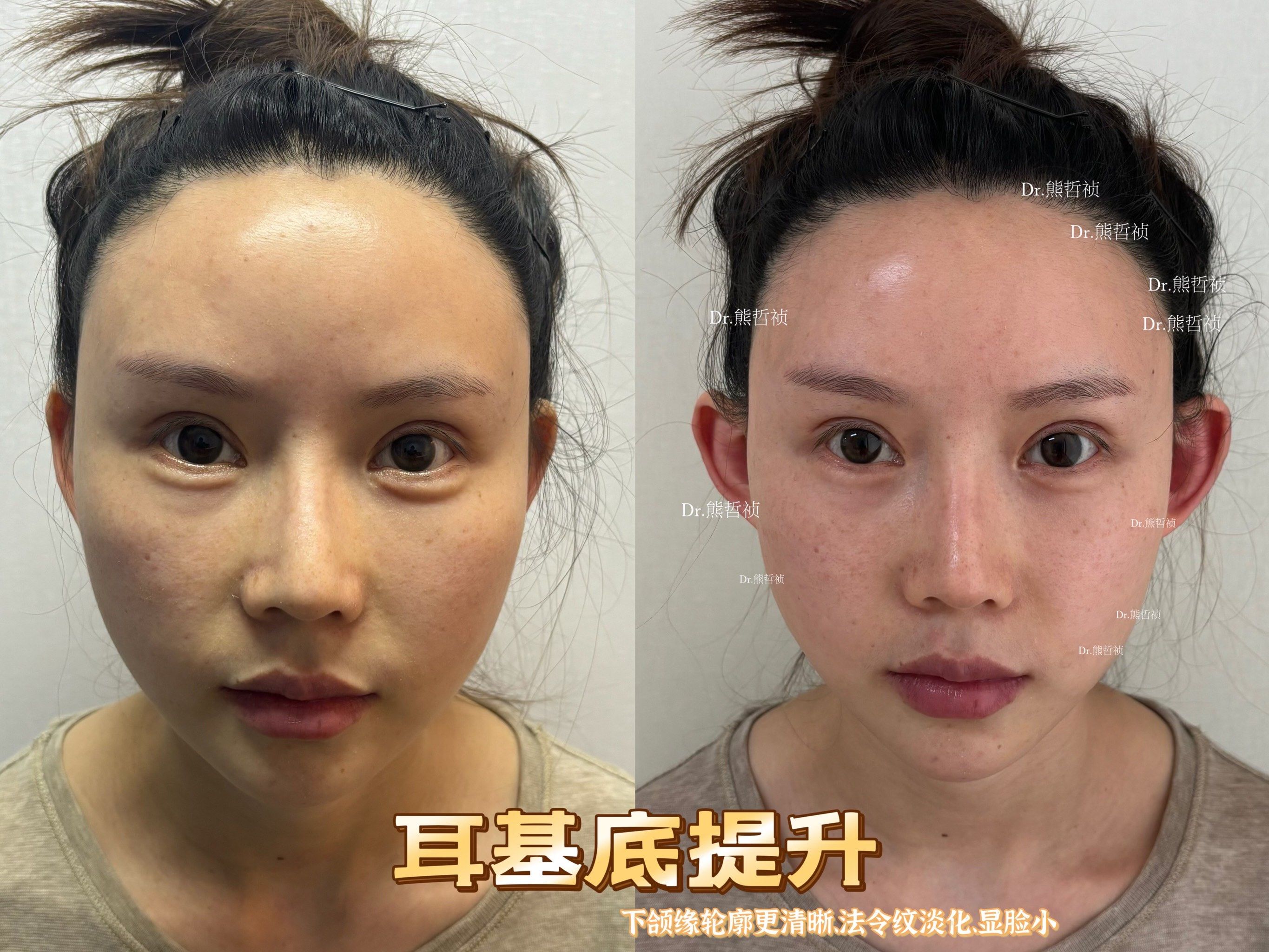 耳基底提升一定程度上能够改善下颌缘和法令