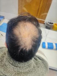 -大麦微针植发全国连锁