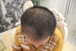 点击看大图 -大麦微针植发丨全国连锁