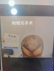 体验后-北京雍禾植发医院