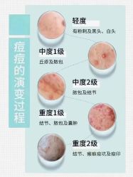 -痘庄科学祛痘国际连锁