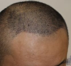 -大麦微针植发全国连锁