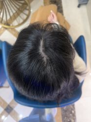 -碧莲盛·不剃发植发