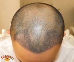 -大麦微针植发丨全国连锁