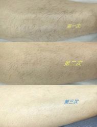 -薇兰专业脱毛连锁机构