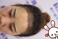 点击看大图 -大麦微针植发丨全国连锁