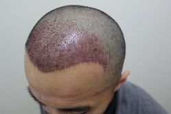 点击看大图 -大麦微针植发丨全国连锁