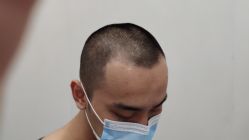 -大麦微针植发全国连锁