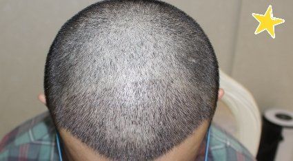 -大麦微针植发丨全国连锁