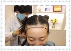 -大麦微针植发全国连锁