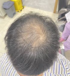 -碧莲盛·不剃发植发
