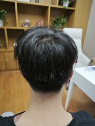 -大麦微针植发全国连锁