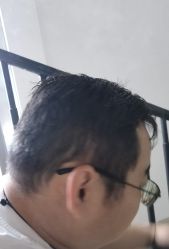 -碧莲盛·不剃发植发