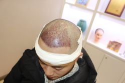 -大麦微针植发丨全国连锁