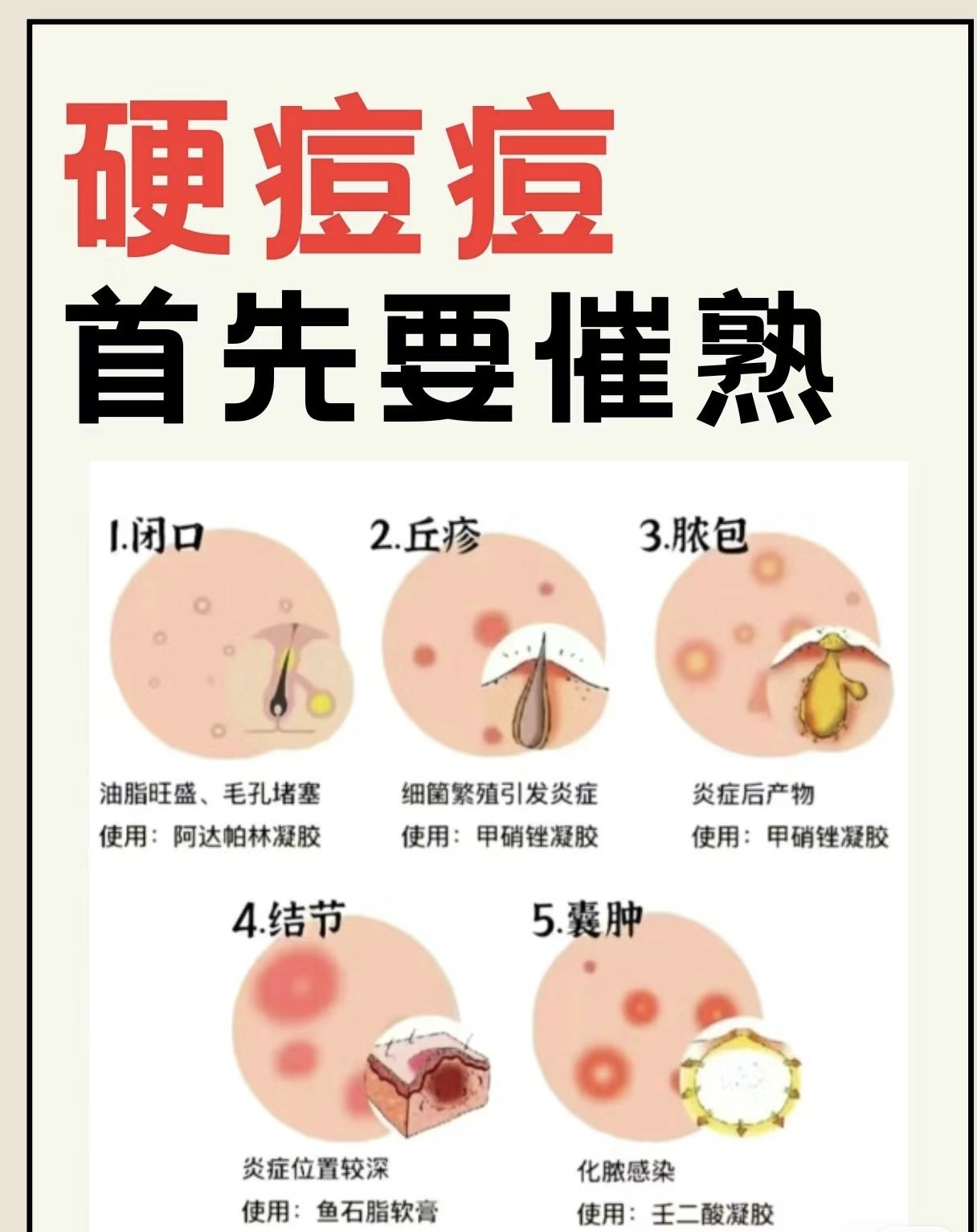 结节痤疮能自愈吗图片