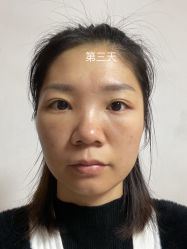 体验后-广州健丽·去眼袋医疗美容机构