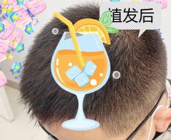 -大麦微针植发全国连锁