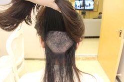 -大麦微针植发丨全国连锁