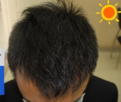 -大麦微针植发丨全国连锁