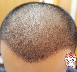 -大麦微针植发丨全国连锁