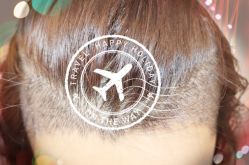 -大麦微针植发全国连锁