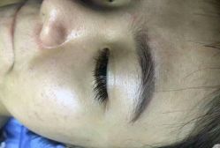 -爱莎扁平疣·汗管瘤·斑痣中心