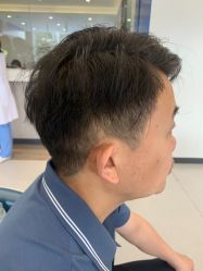 点击看大图 体验后-大麦微针植发全国连锁