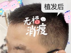 -大麦微针植发全国连锁