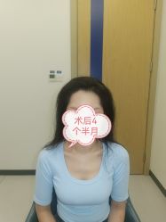 体验后-大麦微针植发全国连锁