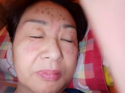 -美丽人生祛斑扁平疣汗管瘤中心