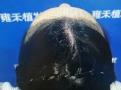 -雍禾植发全国连锁