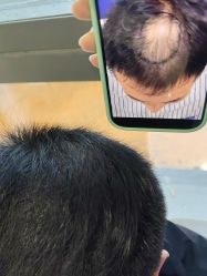 -碧莲盛·不剃发植发