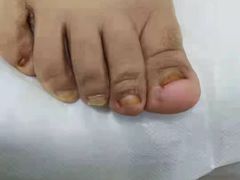 -世龙世家灰指甲鸡眼脚气甲沟炎跖疣护理(通州店)