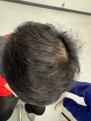 -大麦微针植发全国连锁