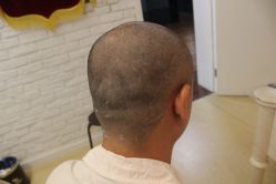 点击看大图 -大麦微针植发丨全国连锁