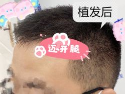 -大麦微针植发全国连锁