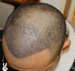 -大麦微针植发丨全国连锁